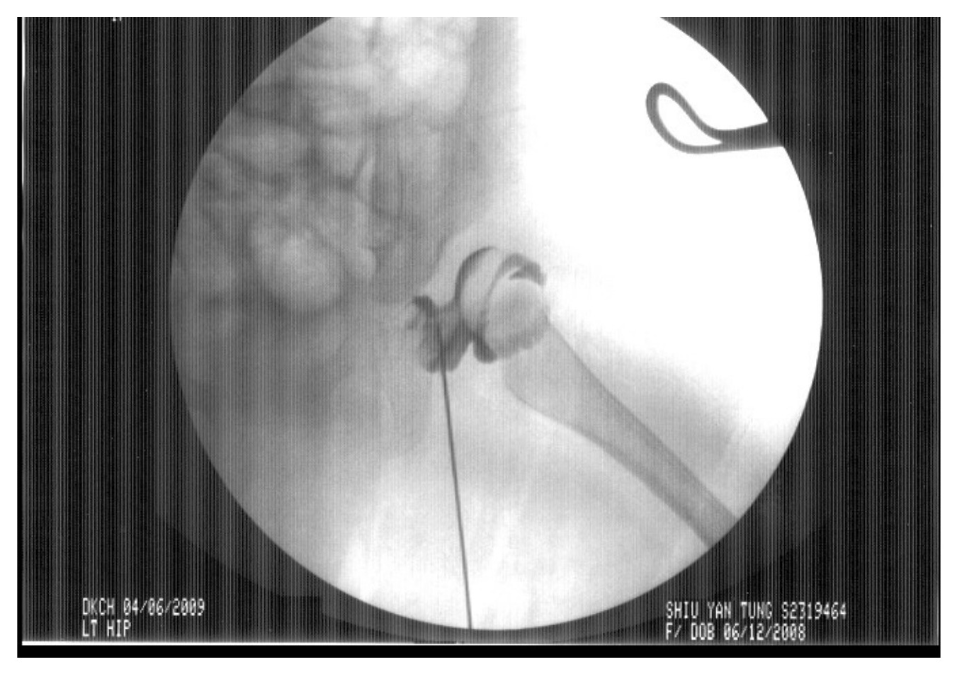 Arthrogram image - arthrogram