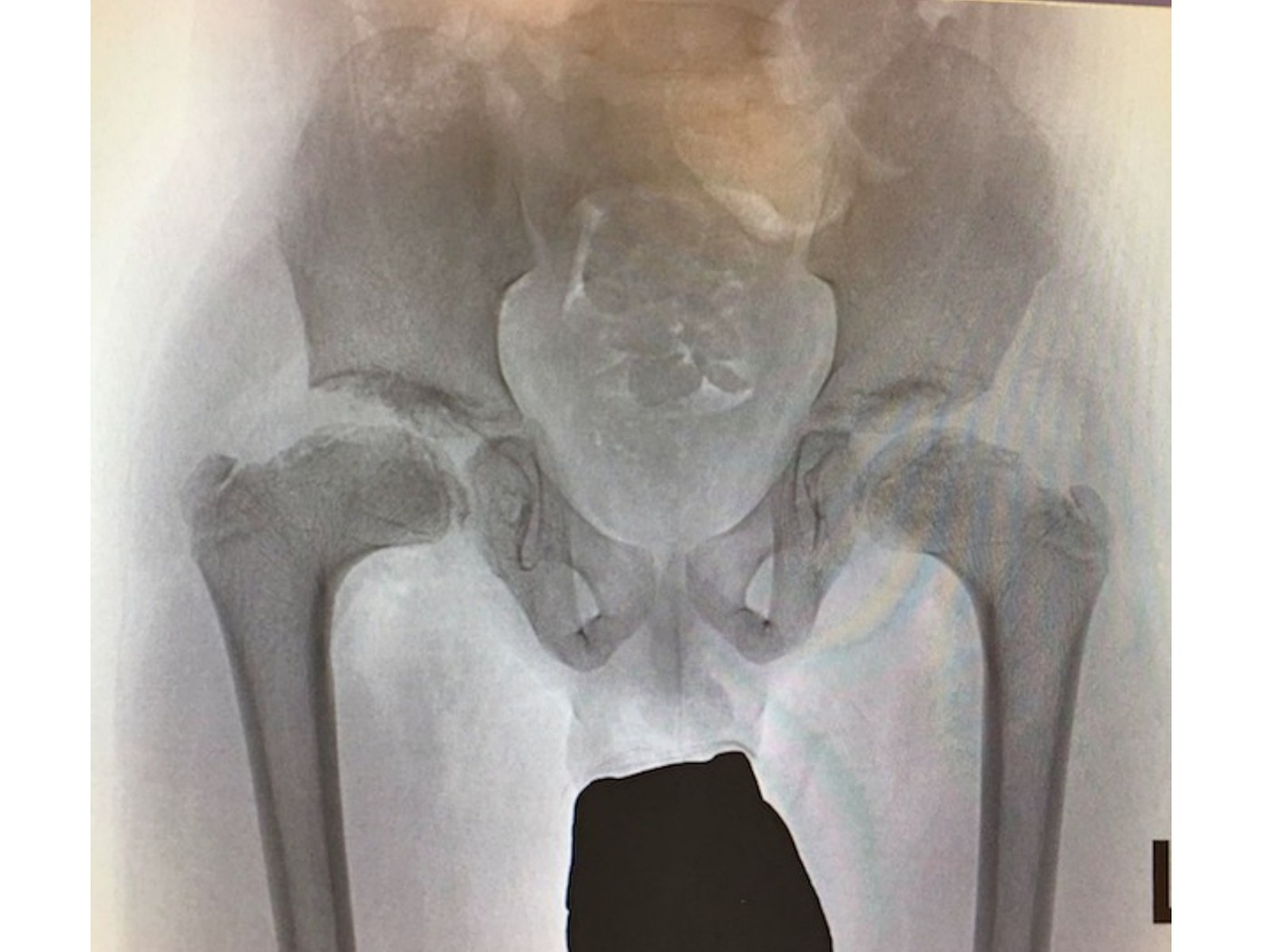 Radiograph / imaging - AVN radiograph