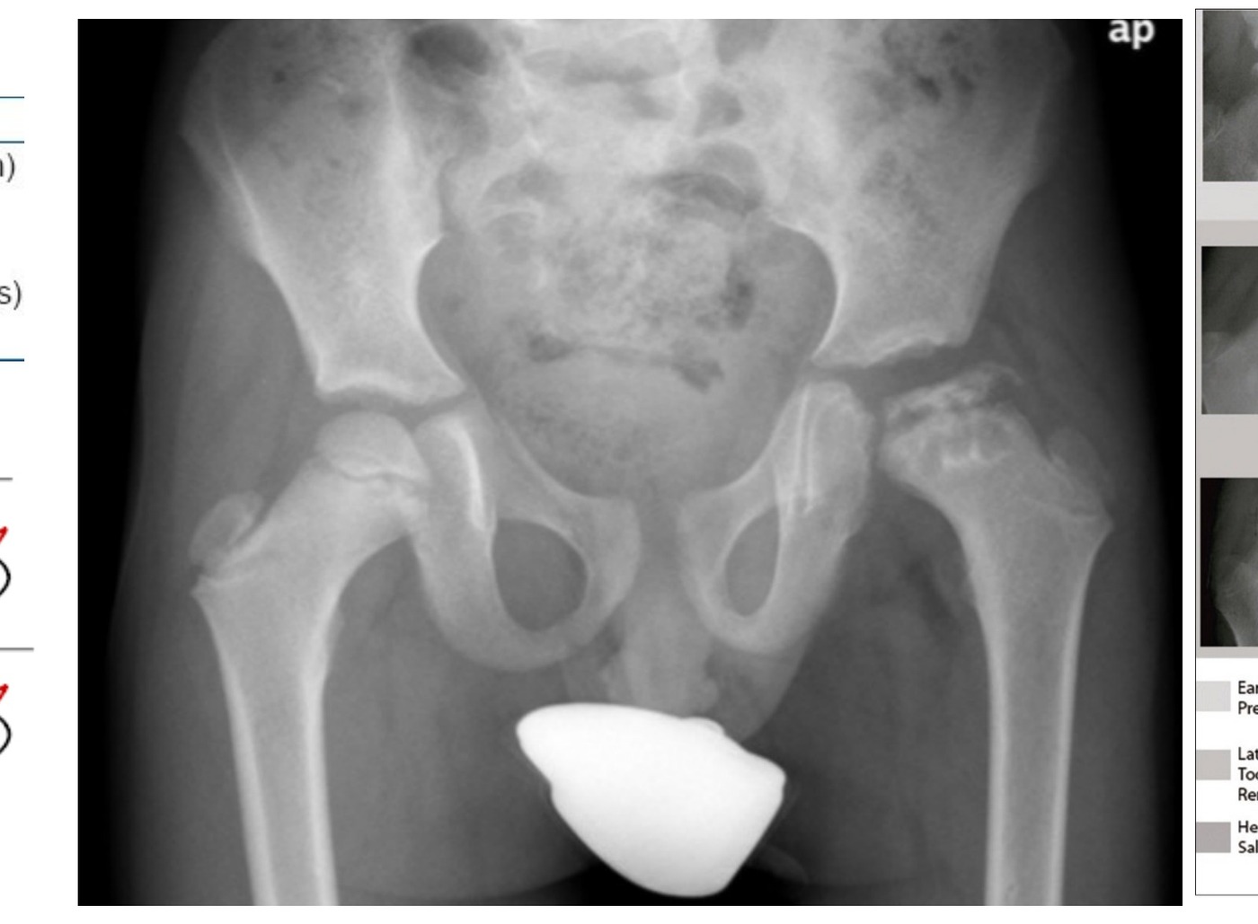 Radiograph / imaging - Perthes radiograph