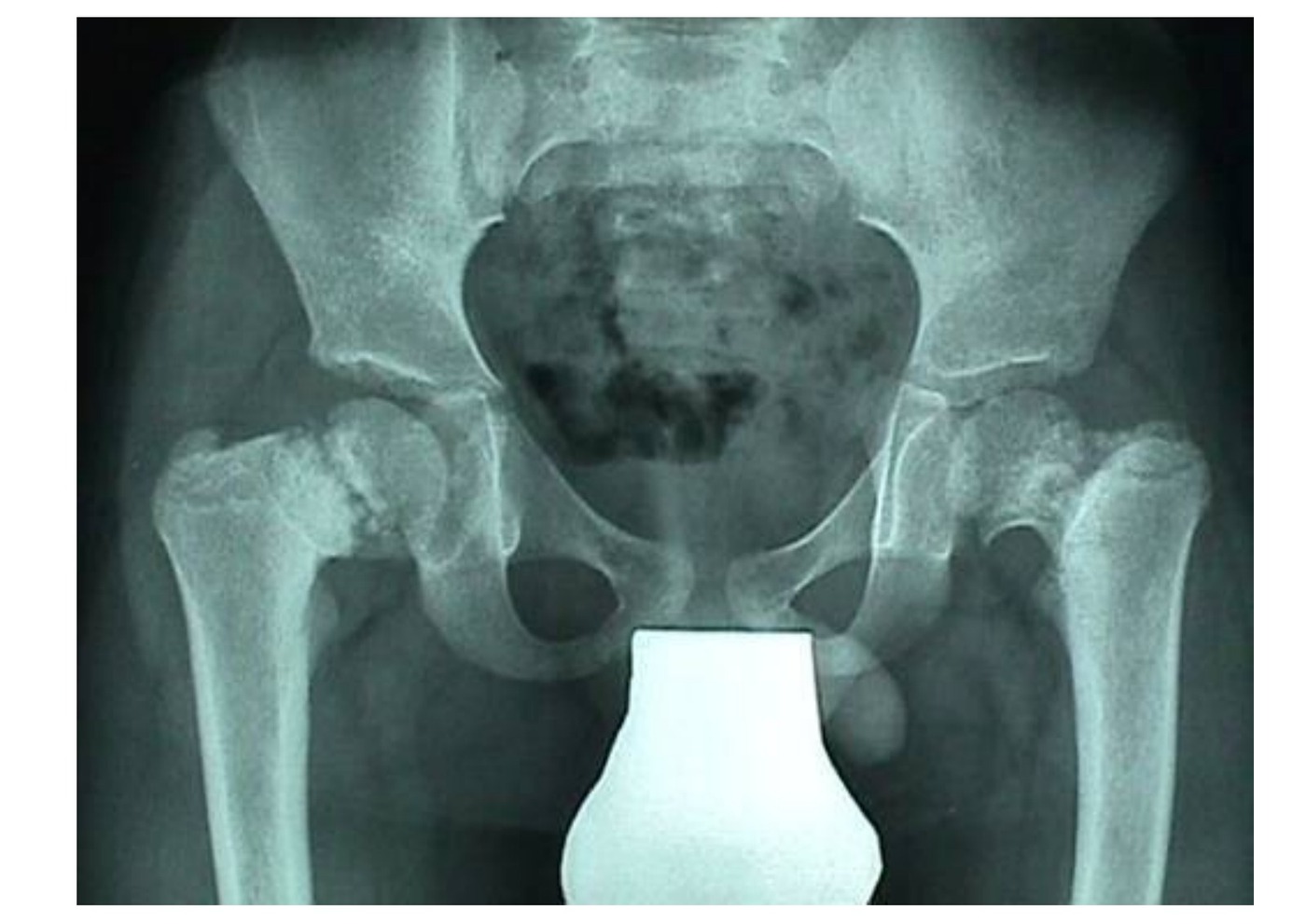 Radiograph / imaging - coxa vara radiograph