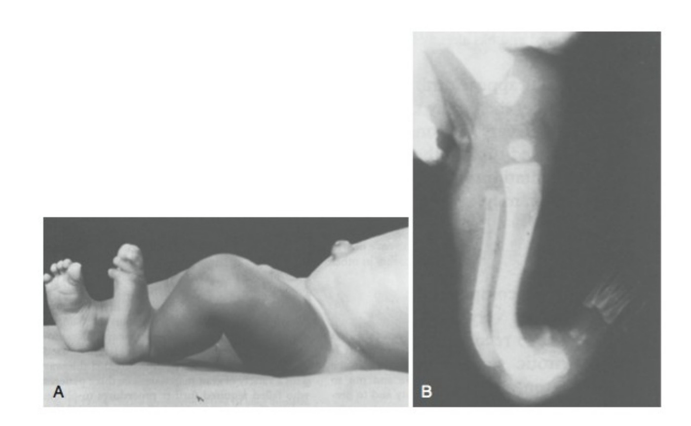 Clinical photograph - posteromedial bowing clinical photograph