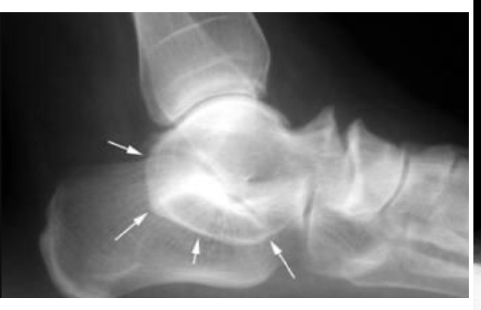 Clinical photograph - tarsal coalition clinical photograph